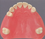 上顎部分床義歯01