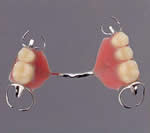上顎部分床義歯02