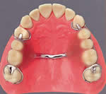 上顎部分床義歯03