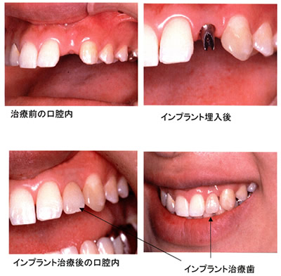 上顎前歯部治療例